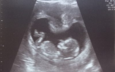 IVF v 35 letech a napoprvé to vyšlo! 2 - Sanatorium Helios CZ Fotka-z-1.screeningu
